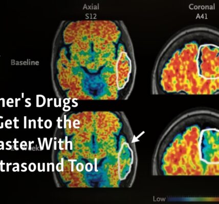 New ultrasound technology could potentially speed up the delivery of Alzheimer's drugs to the brain.