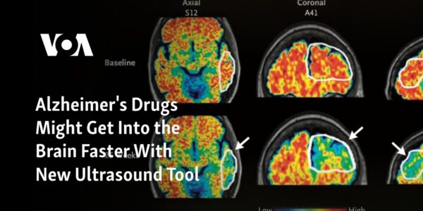 New ultrasound technology could potentially speed up the delivery of Alzheimer's drugs to the brain.