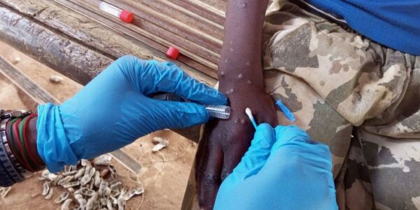 Europe can defeat mpox, must support Africa in getting vaccines: WHO