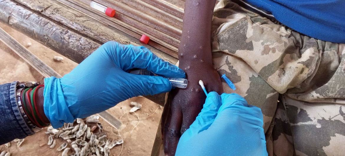 Europe can defeat mpox, must support Africa in getting vaccines: WHO