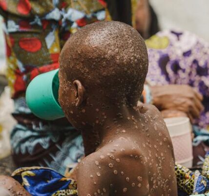 Mpox: Equitable vaccine access crucial for Global South