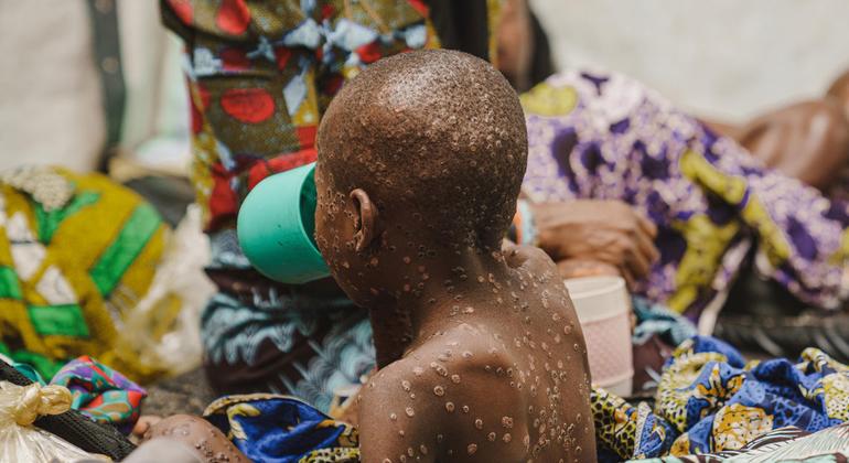 Mpox: Equitable vaccine access crucial for Global South